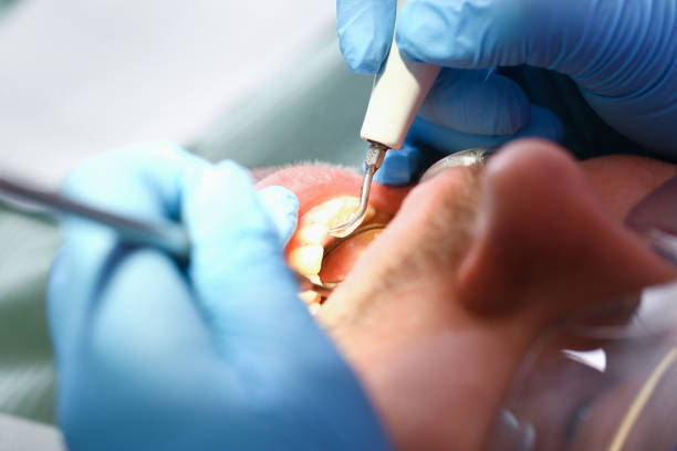 Best Dental Abscess Treatment in West Allis, WI