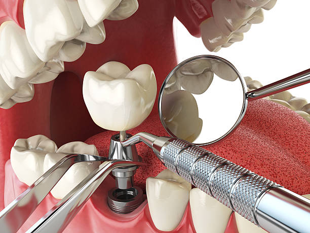 Best Knocked-Out Tooth (Avulsed Tooth) Treatment in West Allis, WI